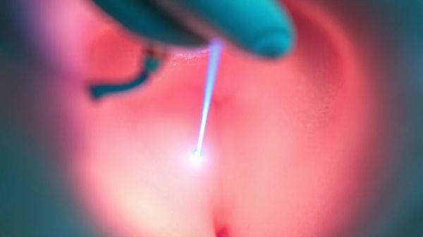 Découvrir comment le laser vaginal combat la sécheresse