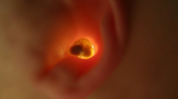 Symptômes d'une oreille bouchée : comment soulager la gêne ?